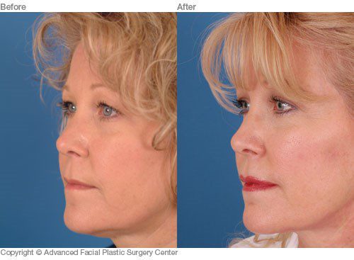 Minimally Invasive Facial Plastic Surgery