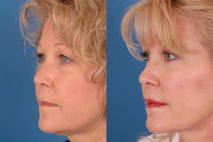 Patient 1 Minilift Before and After MINILIFT 1