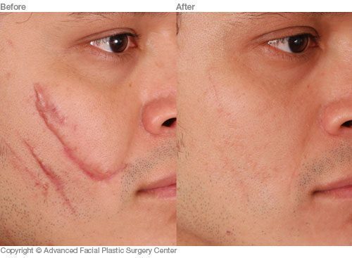 Scar Revision Before & After Photos Benjamin Bassichis