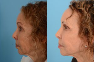 Patient 7 Facelift Before and After