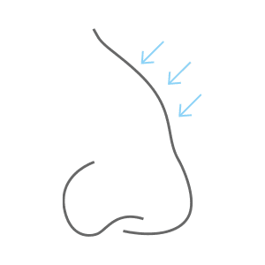 Graphic Depicting Hump on Bridge